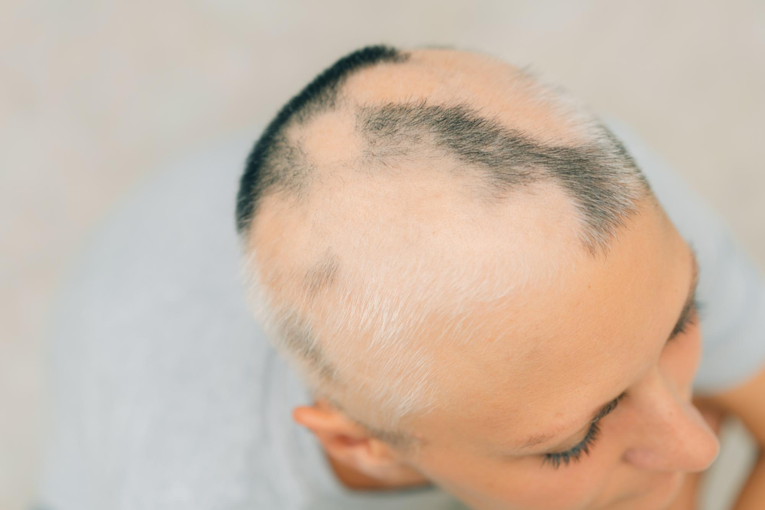 Alopecia areata