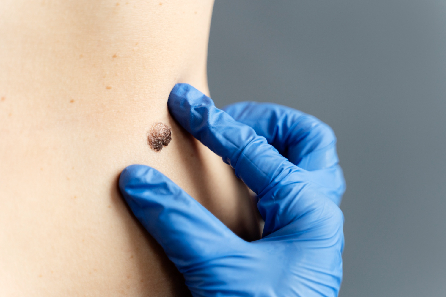 Mole/ Wart/ Skin tag Removal