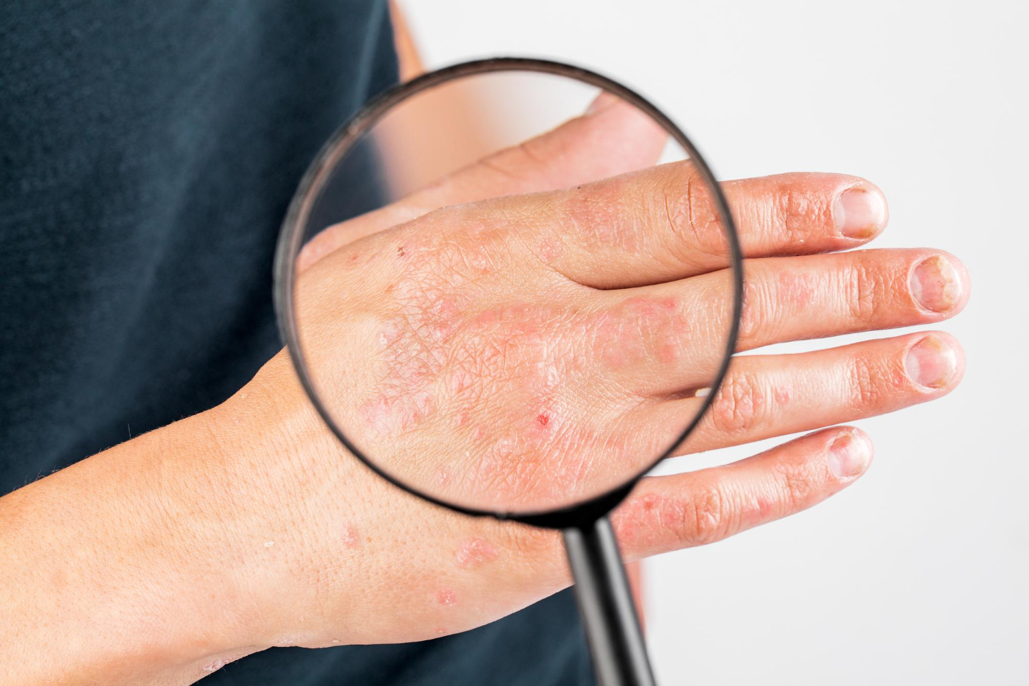 Psoriasis treatment