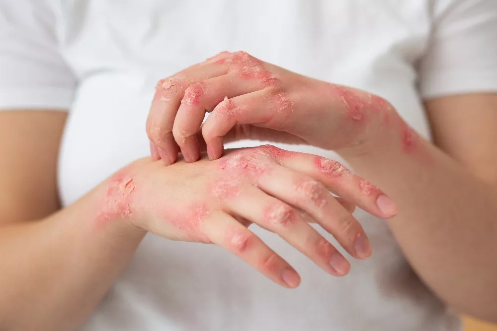 ECzema