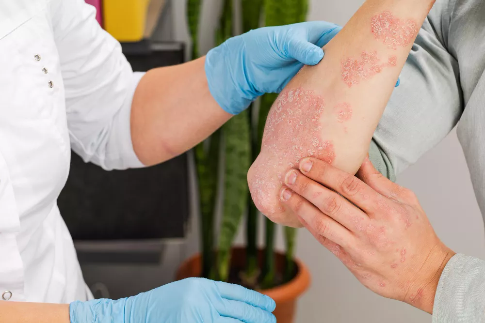 Psoriasis
